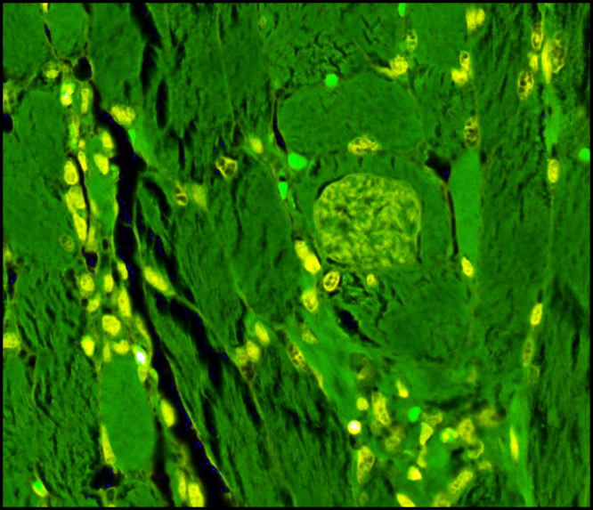 Sarcocystosis